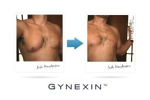 Gynexin After Before Photos